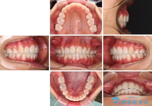 口元の突出感を改善 2年弱での抜歯矯正の治療後