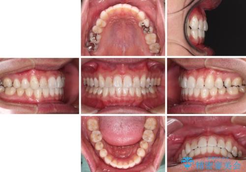 【モニター】 インビザライン・ライトによる軽微叢生の矯正治療の治療後