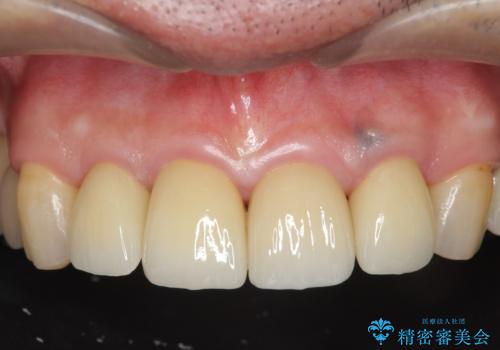 「 放置した虫歯 」 前歯セラミック治療　の症例 治療後