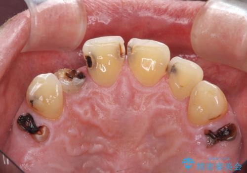 「 放置した虫歯 」 前歯セラミック治療 の治療前