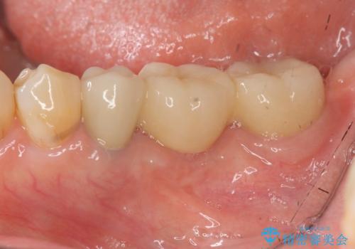 [ 歯牙破折 ]  違和感のある大臼歯 ブリッジ治療