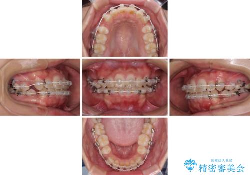 気になる八重歯を治したい 目立たないワイヤーでの抜歯矯正の治療中