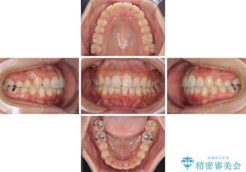前歯のデコボコをインビザラインでスッキリとの治療中