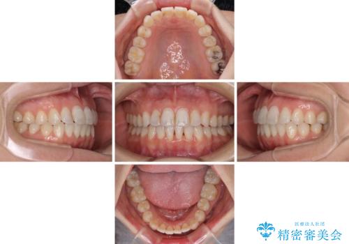 長年気にしていた前歯 インビザラインで目立たず改善の治療中