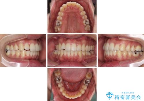 下顎骨が顕著に右側にずれている インビザラインによる咬合改善の治療中