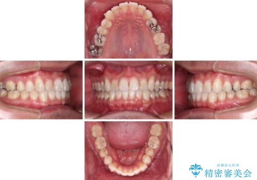 【モニター】 インビザライン・ライトによる軽微叢生の矯正治療の治療中