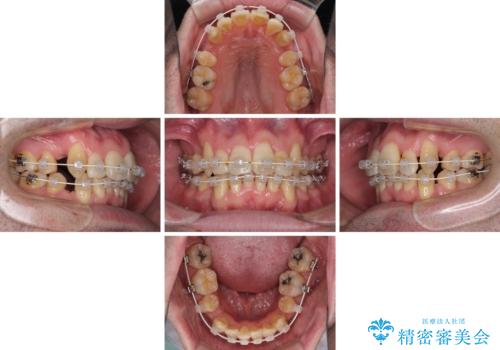 ものが挟まる 著しい叢生を解消 ワイヤー装置による抜歯矯正の治療中