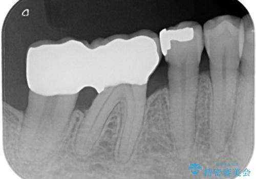 【PGAインレー】深い位置の二次カリエスの治療前