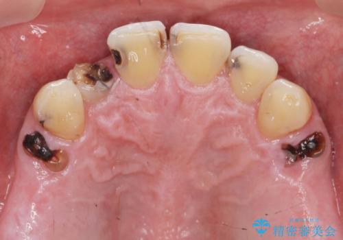 「 放置した虫歯 」 前歯セラミック治療 の治療前