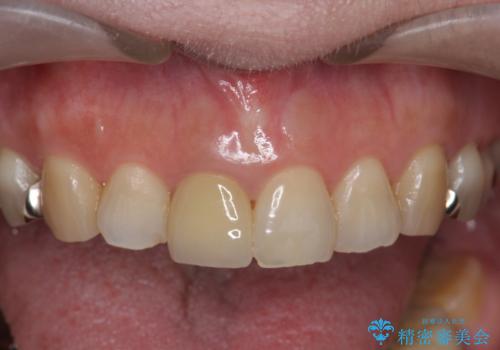 セラミッククラウン 歯ぐきの黒ずみの改善の治療後