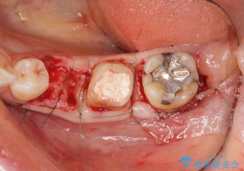 大人になってからの乳歯脱落 セラミックブリッジによる補綴の治療中