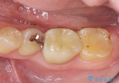 噛むと痛い銀歯　根管治療を伴うやりかえの治療後