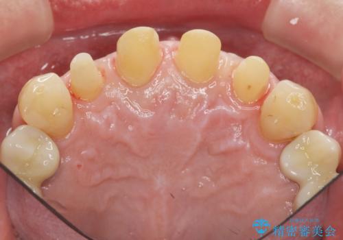 「 放置した虫歯 」 前歯セラミック治療 の治療中