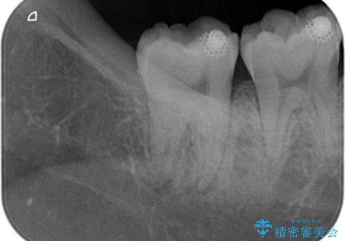 【根管治療】ズキズキ痛い歯の治療の症例 治療前