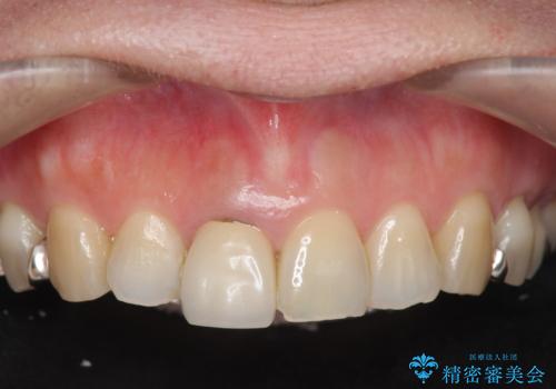 セラミッククラウン　歯ぐきの黒ずみの改善の症例 治療前