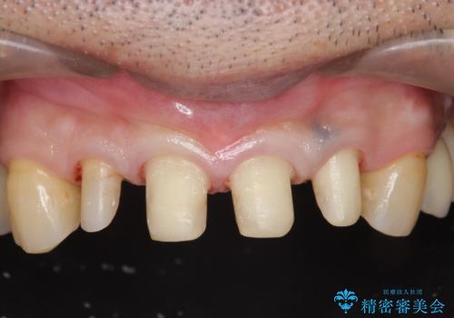 「 放置した虫歯 」 前歯セラミック治療 の治療中