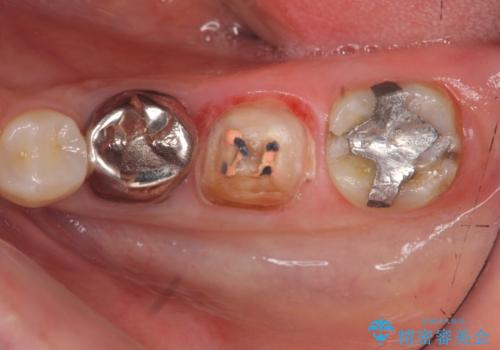 大人になってからの乳歯脱落 セラミックブリッジによる補綴の治療中