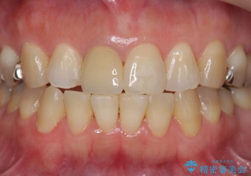 セラミッククラウン 歯ぐきの黒ずみの改善の治療後