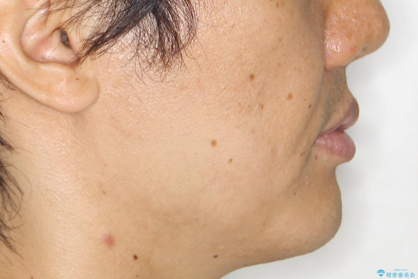 再矯正、後戻りを治したい、マウスピース矯正の治療後(顔貌)