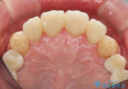 「 放置した虫歯 」 前歯セラミック治療 の治療後