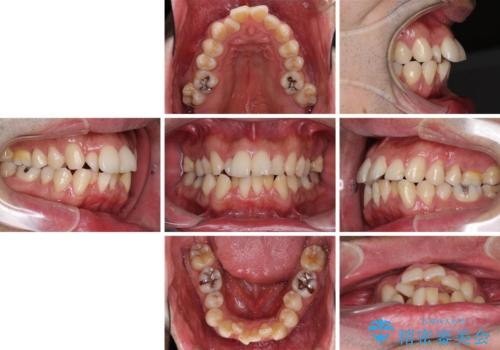 下顎骨が顕著に右側にずれている インビザラインによる咬合改善の治療前