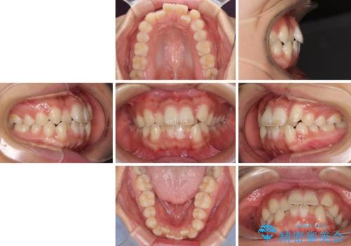 気になる八重歯を治したい 目立たないワイヤーでの抜歯矯正の治療前