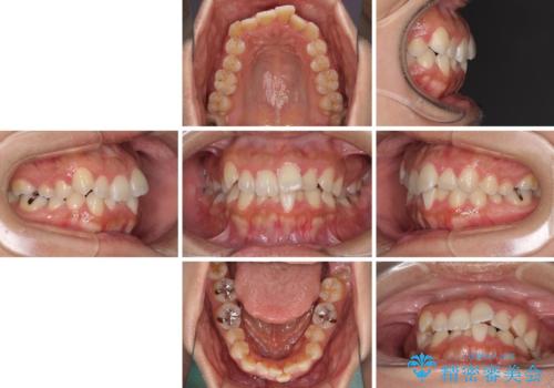 前歯のデコボコをインビザラインでスッキリとの治療前