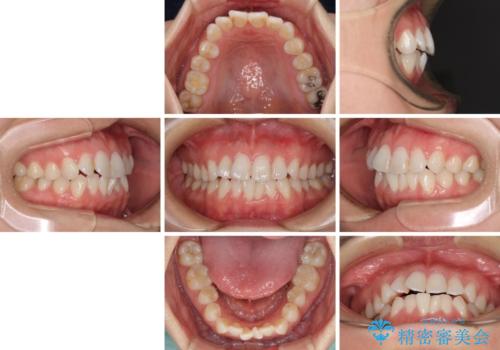 長年気にしていた前歯 インビザラインで目立たず改善の治療前