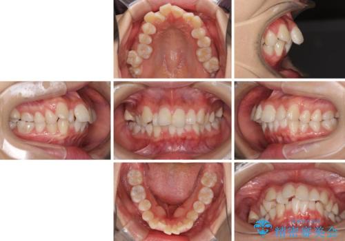 口元の突出感を改善 2年弱での抜歯矯正の治療前