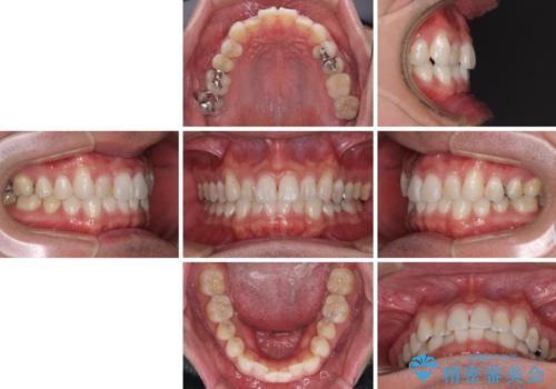 【モニター】 インビザライン・ライトによる軽微叢生の矯正治療の治療前