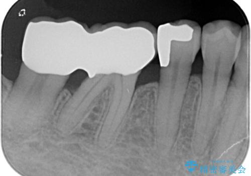 【PGAインレー】深い位置の二次カリエスの治療後