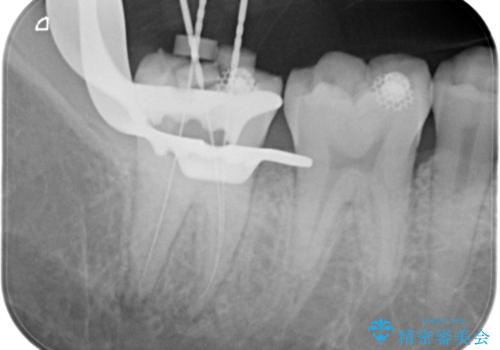 【根管治療】ズキズキ痛い歯の治療の治療中