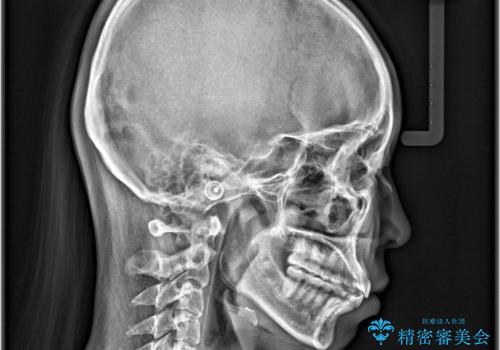 【インビザライン】前歯が出ているのを治したいの治療後