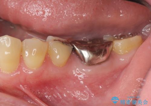 噛むと痛い銀歯　根管治療を伴うやりかえの症例 治療前
