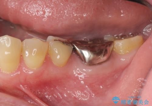 噛むと痛い銀歯　根管治療を伴うやりかえの治療前