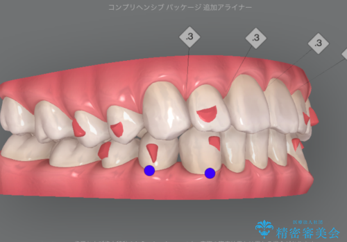 [ Three-incisor ]  歯肉退縮した歯を抜去しマウスピース治療で改善