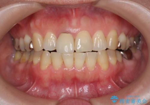 セラミッククラウン　歯ぐきの黒ずみの改善の治療前