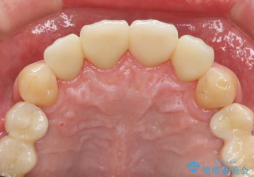 「 放置した虫歯 」 前歯セラミック治療 の治療後