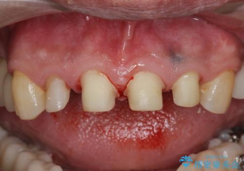 「 放置した虫歯 」 前歯セラミック治療 の治療中