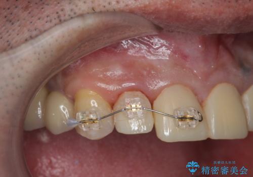 「 放置した虫歯 」 前歯セラミック治療 の治療前