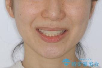 上下の真ん中を合わせて横顔シルエットも改善の治療後(顔貌)