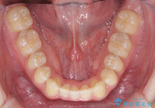 [ Three-incisor ]  歯肉退縮した歯を抜去しマウスピース治療で改善の治療後