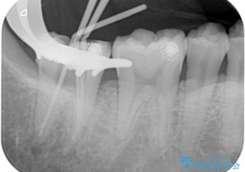 【根管治療】ズキズキ痛い歯の治療の治療中