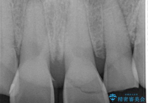 折れた前歯を使えるように、抜かないで残す方法の治療前