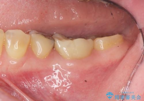 噛むと痛い銀歯　根管治療を伴うやりかえの症例 治療後