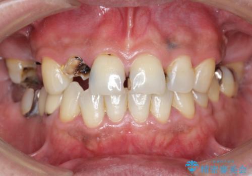 「 放置した虫歯 」 前歯セラミック治療 の治療前