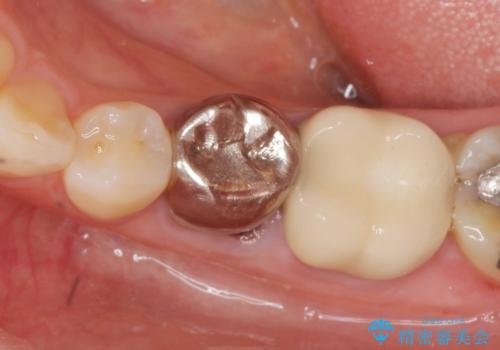 大人になってからの乳歯脱落 セラミックブリッジによる補綴の治療前