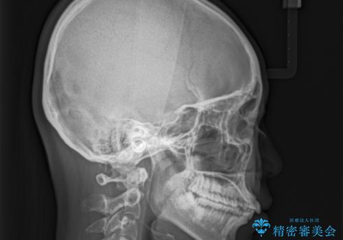 【インビザライン】前歯が出ているのを治したいの治療前