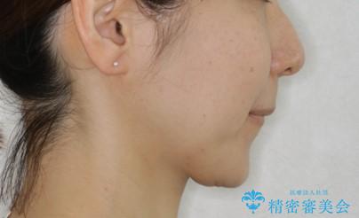 上下の真ん中を合わせて横顔シルエットも改善の治療前(顔貌)