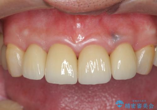 「 放置した虫歯 」 前歯セラミック治療 の治療後